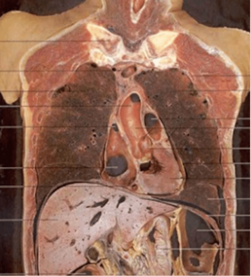 Asymmetrical body and internal organs